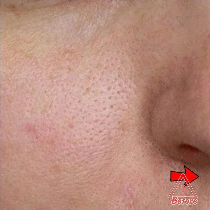 Soro de encolhimento de poros repara poros grandes Soro facial de ácido salicílico Soro facial anti-rugas