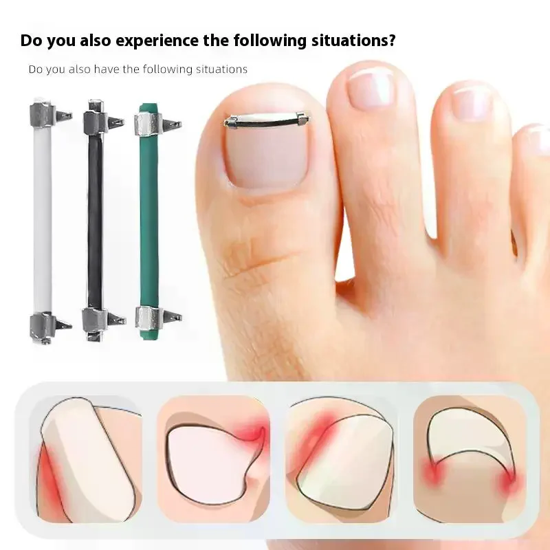 陥入爪矯正クリップ プロ仕様の湾曲したクランプ ペディキュアツール 陥入爪ケア＆埋没爪矯正用