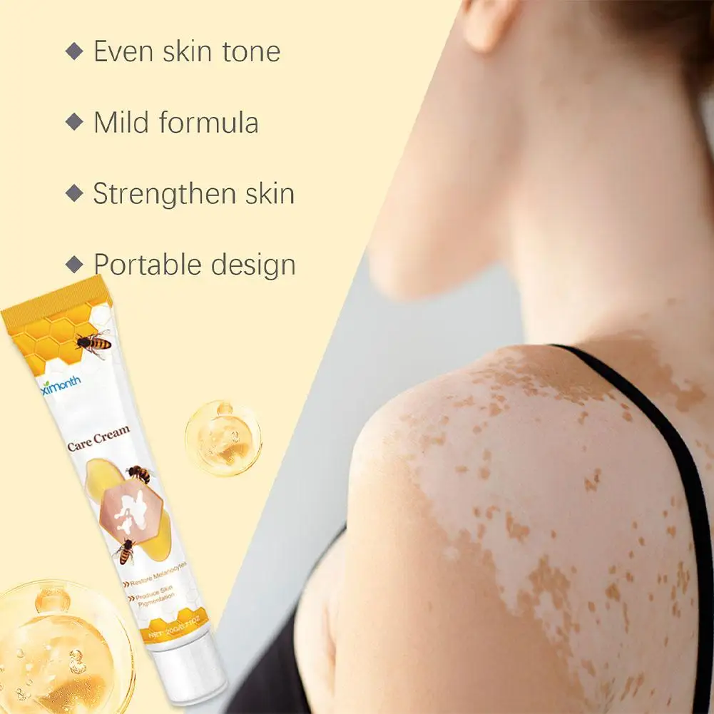 Vitiligo Tratamento Bee Cream, spray de alívio, tratamento da pele lâmpada, mancha branca remoção pomada, eliminar vitiligo