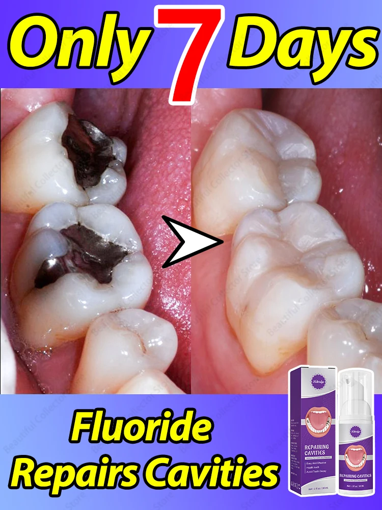 Tooth decay Repair Repairing Cavities Anti Protecting Caries