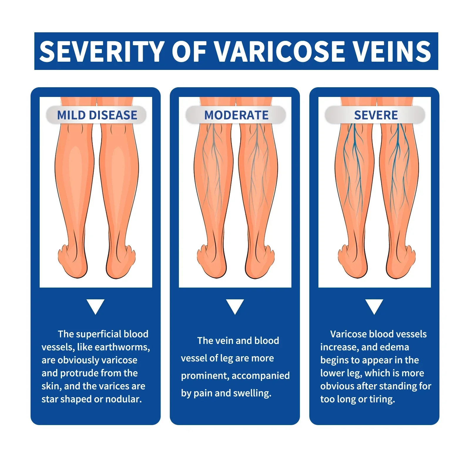 Effectieve Spataderspray Natuurlijke Kruidaders Kalmeren Essentiële Spray Vasculitis Flebitis Spinnenader Regenworm Been Cure