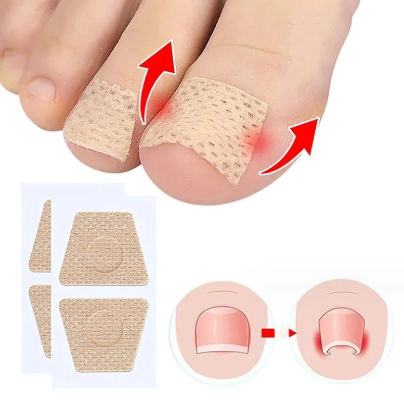 Pegatinas de corrección de uñas encarnadas, parches para el cuidado de los pies, tratamiento de paroniquia, herramienta de pedicura, 2/10 piezas