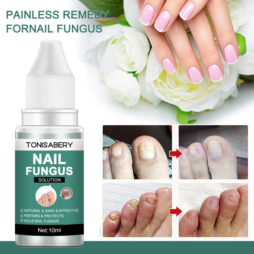 Nail Fungal Treatment Feet Care Essence Anti Infection Onychomycosis Removal Toe Nails Foot Fungus Paronychia Nail Care Uñas