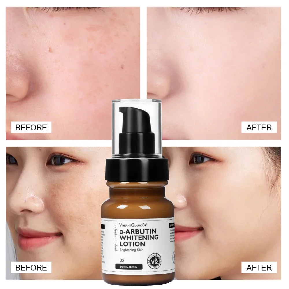 A- Arbutin Lotion Can Lighten Spots Chloasma Freckles Remove Acne Marks It Has The Effect Of Whitening Brightening The Skin