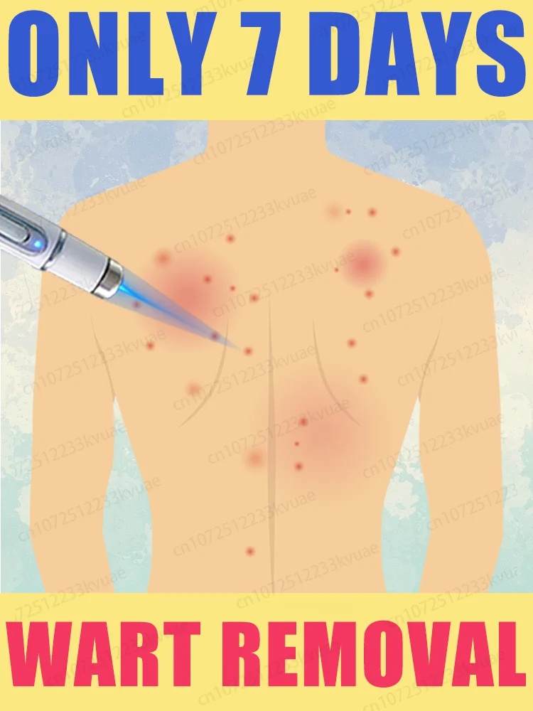 

Warts blue light tool, more discounts on sets