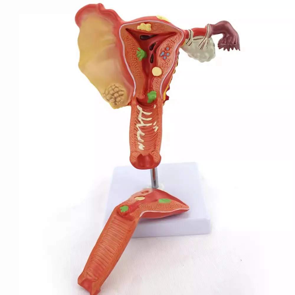 

Человеческая женская матка, яичник, патологическая модель, анатомическая анатомия, поперечный разрез, медицинские обучающие инструменты