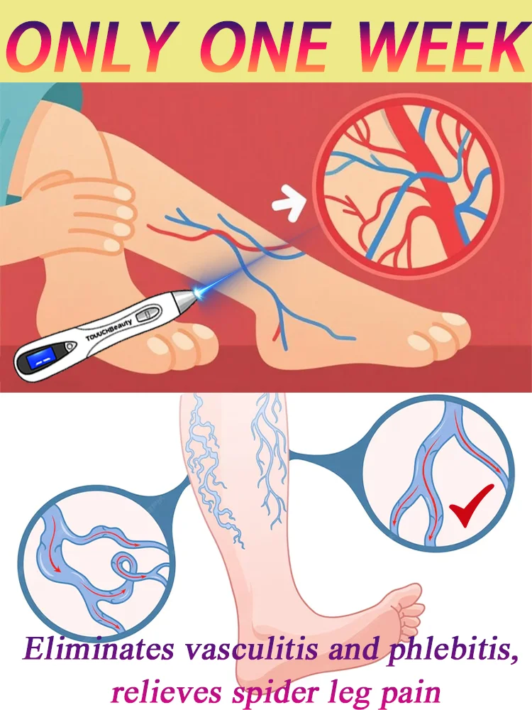 

Vaziazi, усовершенствованное оборудование, безболезненное лечение вен-паука