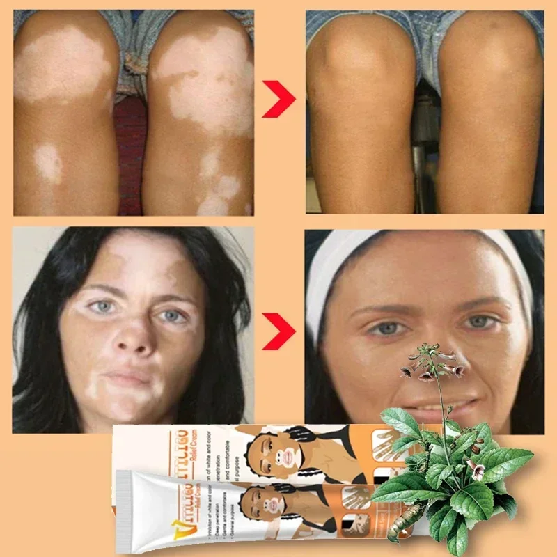 

Vitiligo Treatment Cream Relief Spray Skin Treatment Lamp White Spot Removal Vitiligo Ointment Eliminate Skin Treatment