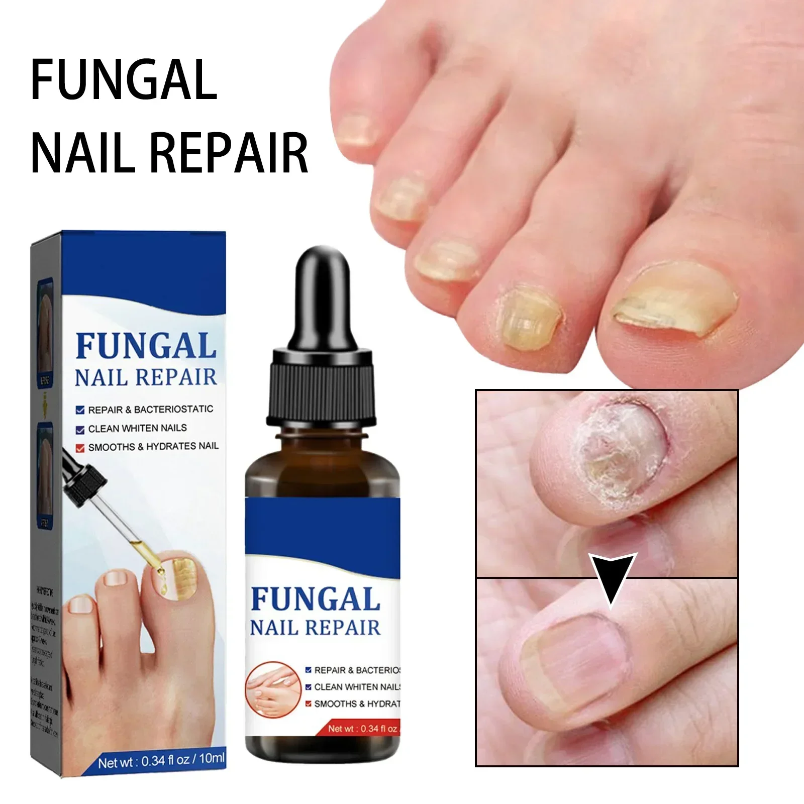 Fungal Nail Treatment Oil Foot Repair Essence Toe Nail Fungus Removal Gel Anti Infection Cream Fungal Nail Removal Paronychia