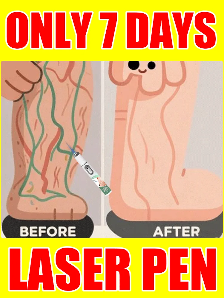 

2nd generation laser venous treatment pen, used to treat varicose veins