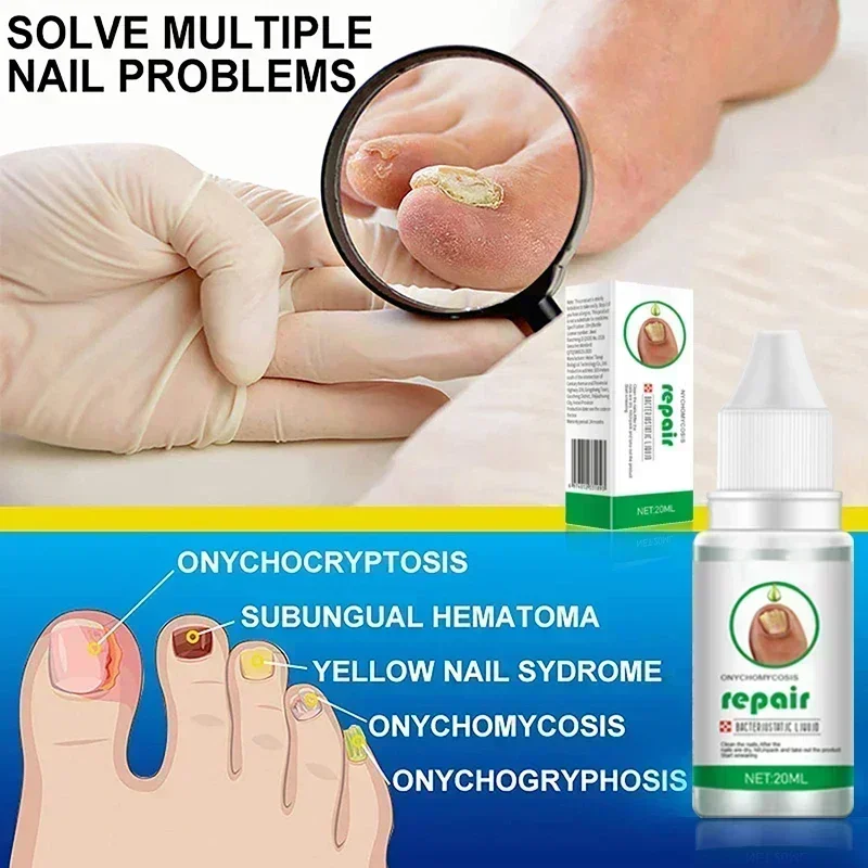 Nail Fungus Tratamento Soro, Toe Fungal Repair Products, Hand Foot Care, Gel de remoção, Anti infecção, Onicomicose, Paroníquia