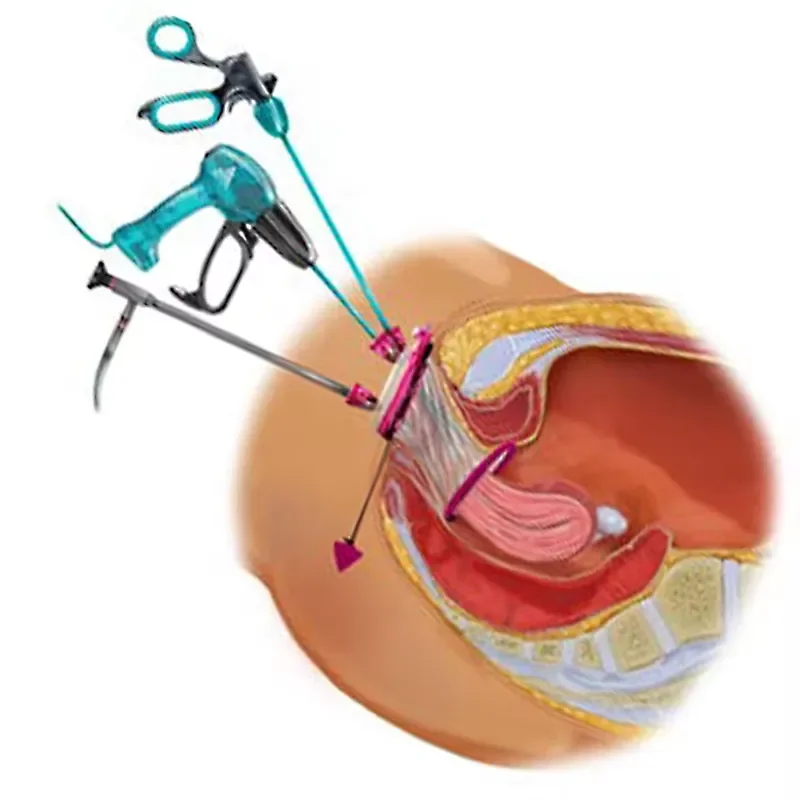 Transparent Professional Multi-channels Transvaginal Single Port V-Path Access Platform for V-NOTES Hysterectomy