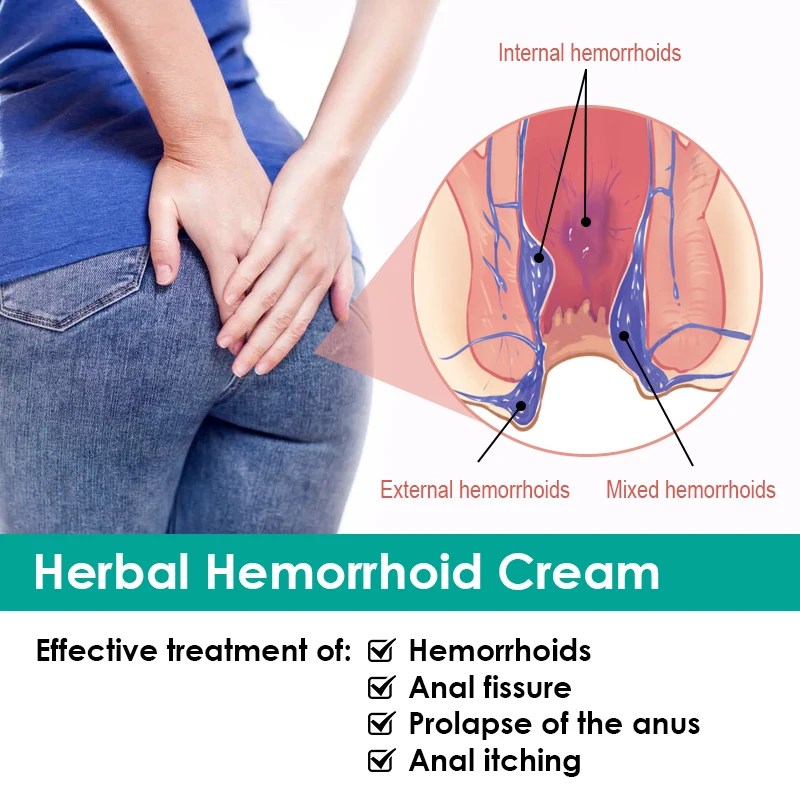 1pcs Hemorrhoid Pain Relief Cream Anal Swelling Bleeding Hemorrhoid Treatment Ointment Medical Hemorrhoid Removal Cream S001