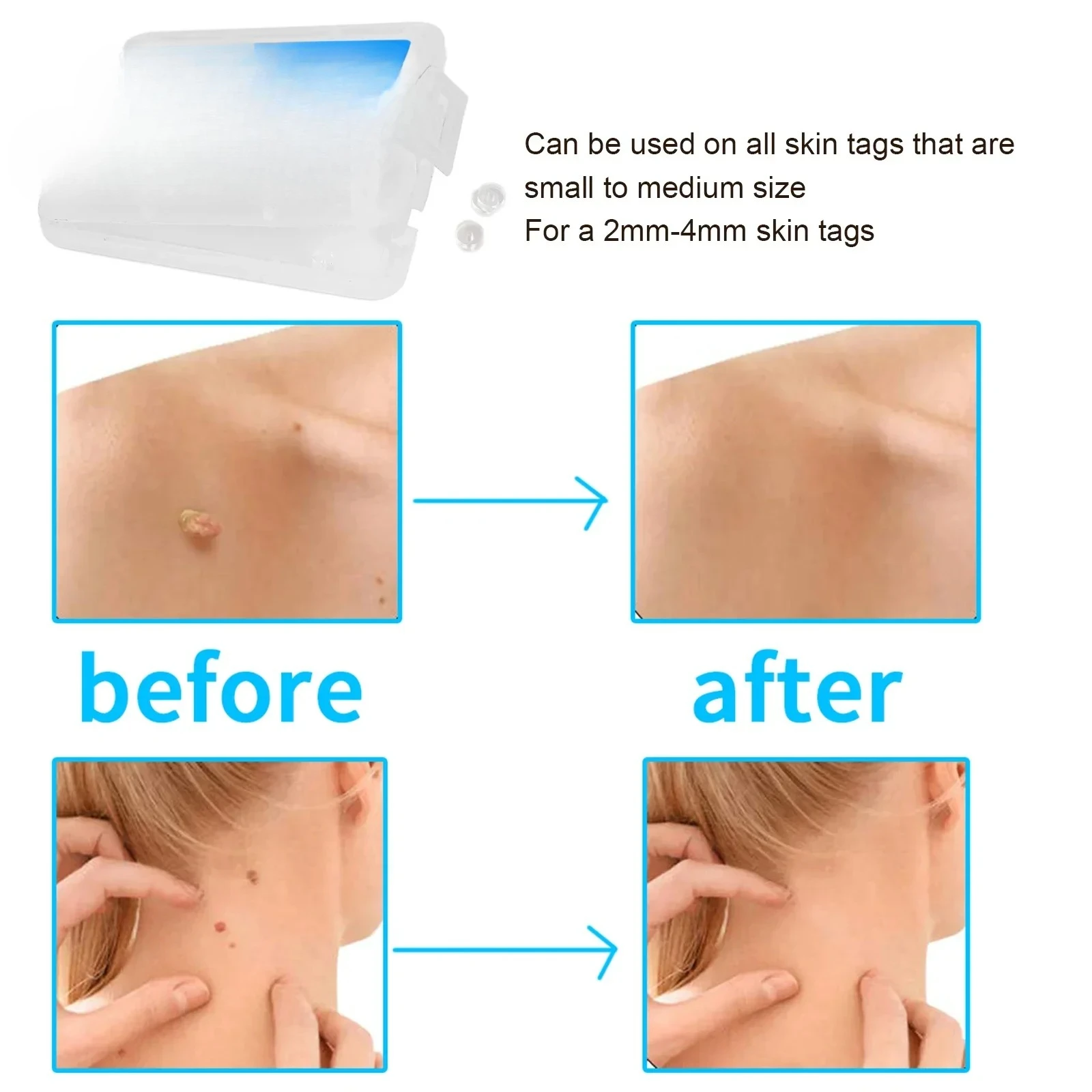 30Pcs Removal Rubber Bands Micro Band Non Toxic Mole Wart Micro Refill Band Skin Tag Removal Bands Skin Care Tools