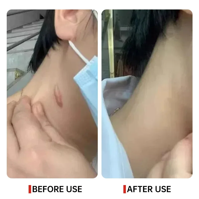 Fast Scar Removal Cream Effective Treatment Stretch Marks Burn Surgical Scars Acne Spots Repair Whitening Moisturizing Skin Care