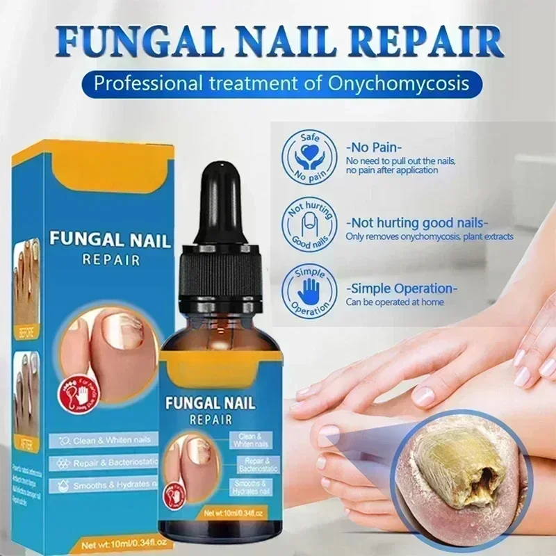 Óleo para tratamento de unhas fúngicas, essência para reparo de pés, gel para remoção de fungos nas unhas dos pés, creme anti-infecção, remoção de fungos nas unhas, paroníquia