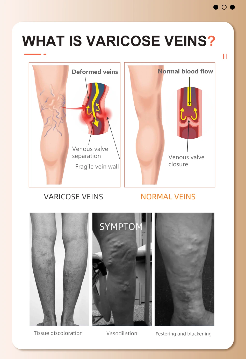 Legbeauty Medizinische kniehohe Kompressionsstrümpfe mit offenem Zehenbereich, Klasse 3, 30–40 mmHg, Wadenstützsocken in Übergröße, abgestufter Druck – Detail 6