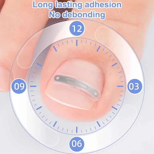Cuidado de las uñas corrección de uñas encarnadas tratamiento de uñas encarnadas parche elástico pegatina alisado Clip herramienta de pedicura