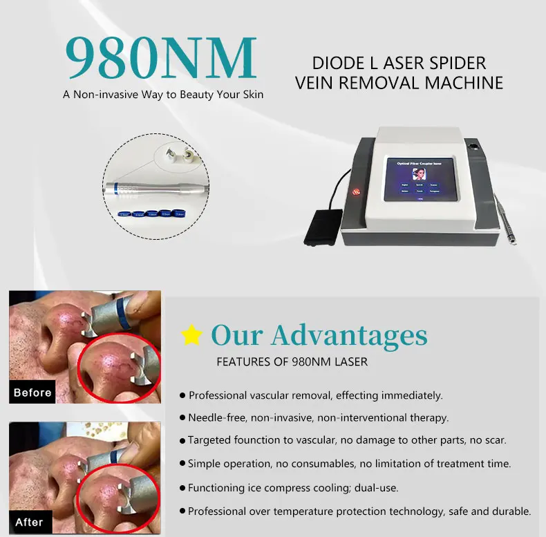 2024 Best 30W 60w 980nm Diode Laser Spider Vein Removal Machine Vascular Removal Machine High Frequency Spider Vein Removal