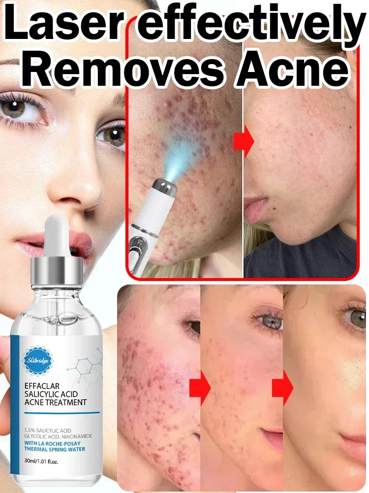 acne laser anti Acne serum