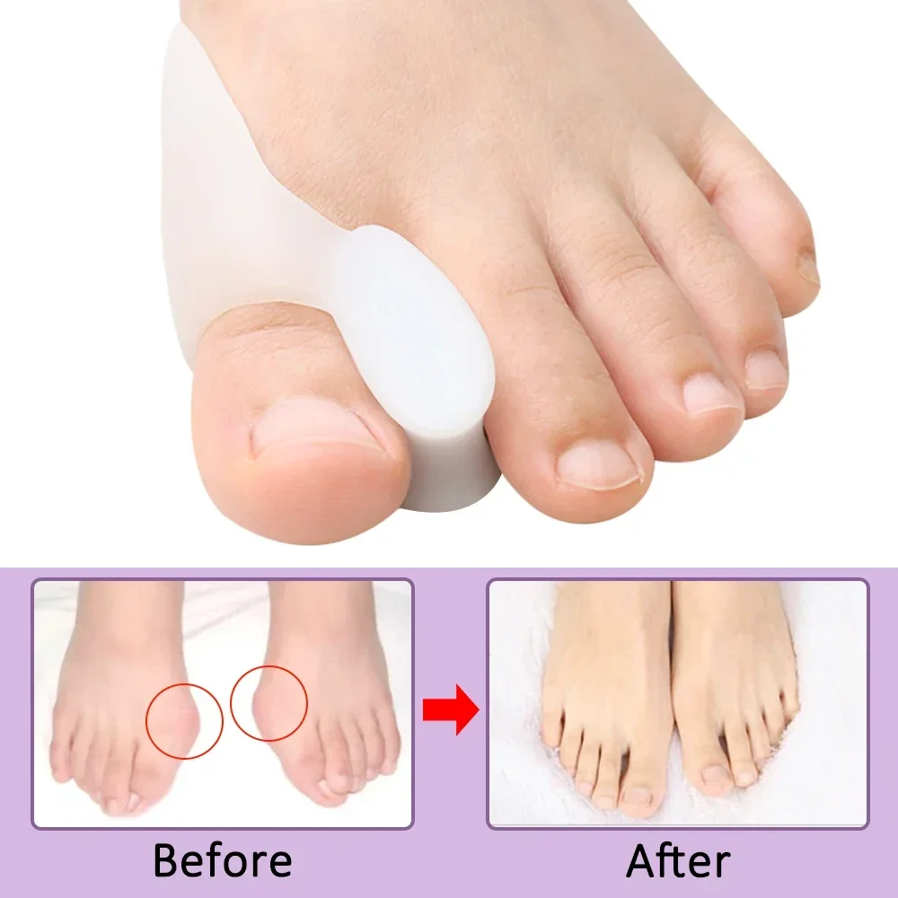 2/4/8Pcs Protector Spacer Toe Separator Gel Big Bunion Corrector Pain Relief Hallux Valgus Straighter Orthopedic Toe
