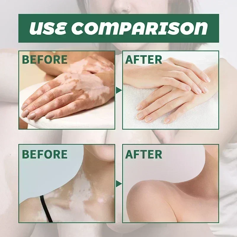 Vitiligo pomada para remoção de manchas brancas, micose, eficaz para remover a pele branca, eliminar o corpo e pele cuidados