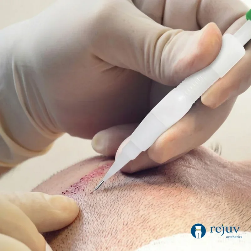 Reusable DHI Professional Hair Transplant Pen Choi Pen Spring-loaded Hair extracting implant individual follicles - view 3