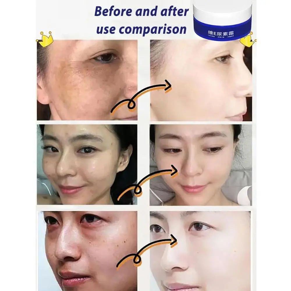 美白スポットフェード尿素クリームは、ダークスポットを減らし、そばかすを除去します。フェイスクリームは、均一な肌の色合いを整え、しわを減らします。フェイスモイスチャライザーです。