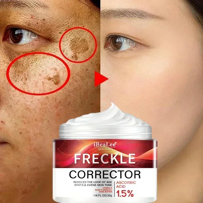 Niacinamide Dark Spots Remover Serum Freckle Whitening Moisture Powerful Removal Black Dot Melasma Chloasma Face Skin Care Cream