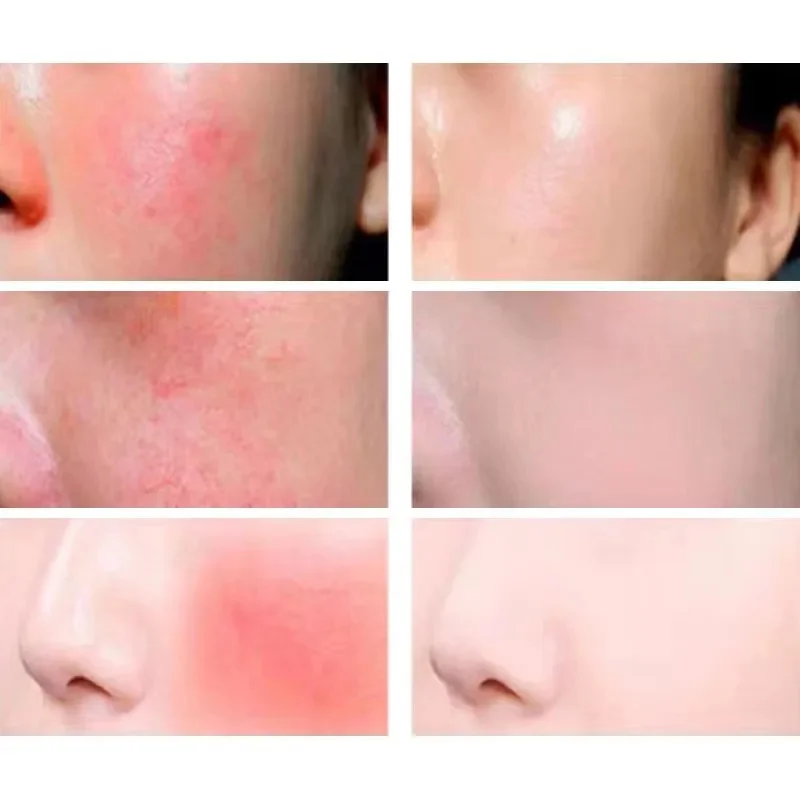 페이셜 레드니스 리페어 크림 민감성 피부 건조함 개선 모이스처라이저 하이드레이팅 수딩 로션 제거 Rosacea 한국 화장품