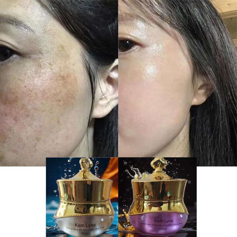 

Вьетнамский осветляющий крем 1 шт., устраняет темные пятна и следы от акне, увлажняет, подтягивает кожу и выравнивает тон.