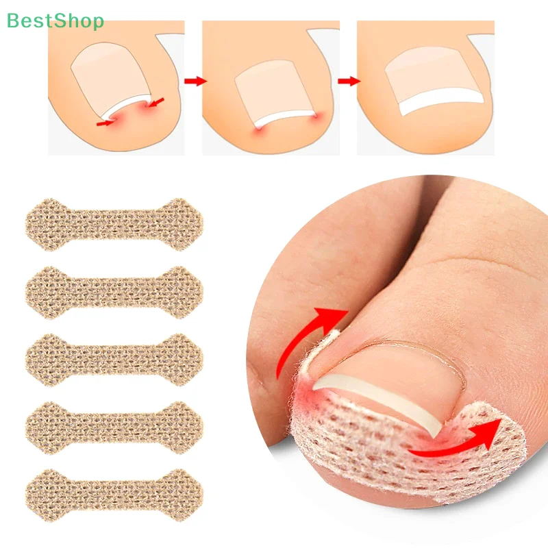 💦Ingrown Toenail Correction Patch 60Pcs,Prevent Ingrown Nails,Anti Nails Into The Flesh Long Toe Pad