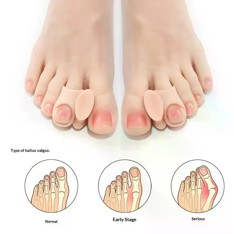 1 Pairs Silicone Toe Separator Bunion Bone Ectropion Adjuster Toes Outer Appliance Foot Care Tool Hallux Valgus Corrector