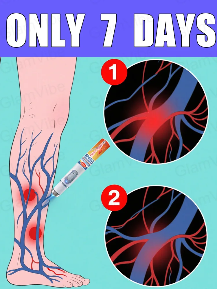 

Generation-2 Laser Says Goodbye To Spider Legs Varicose In 7 Days
