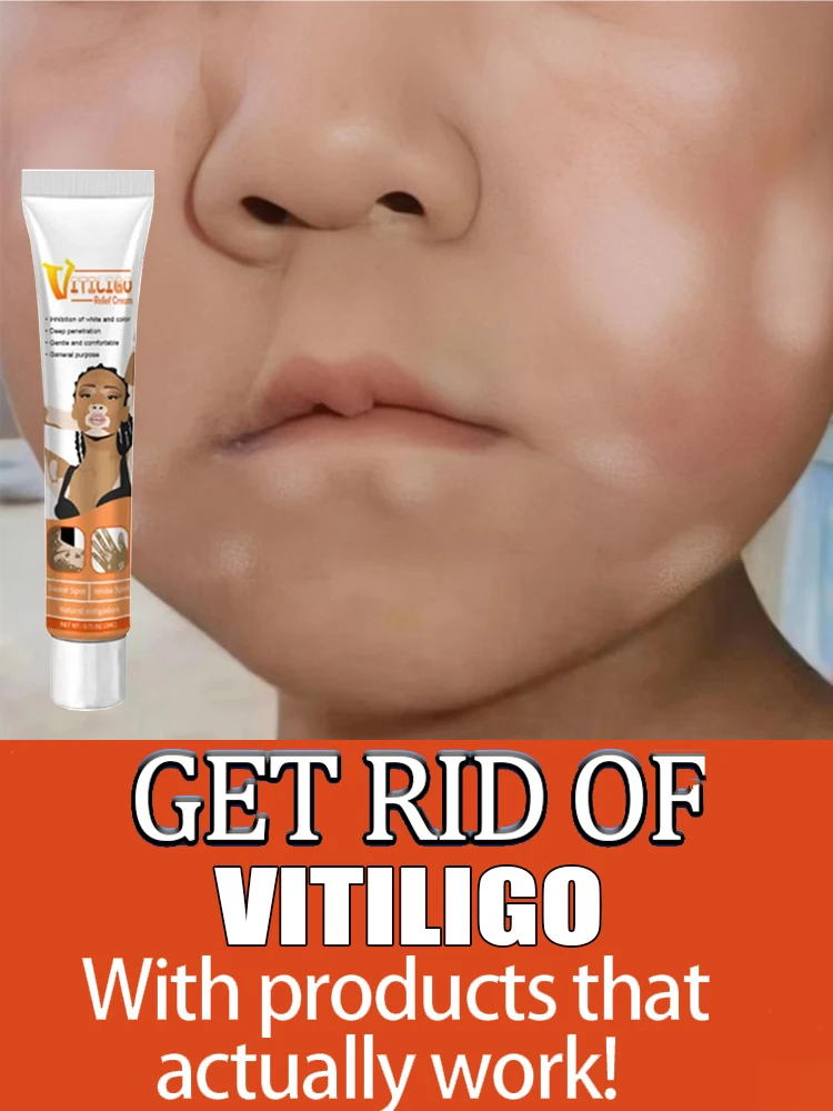 Effectively Remove Vitiligo Ointment Ringworm White Spot Removal Skin Vitiligo Eliminate Vitiligo Skin Care