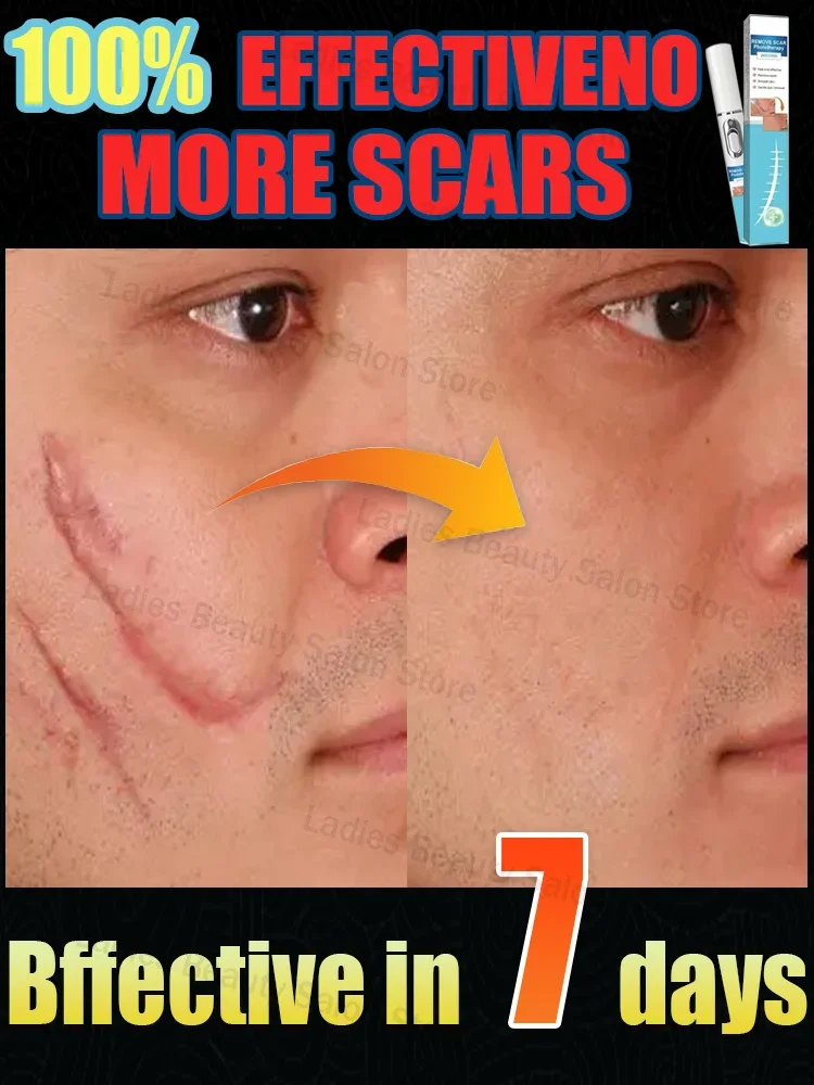 Scars disappear