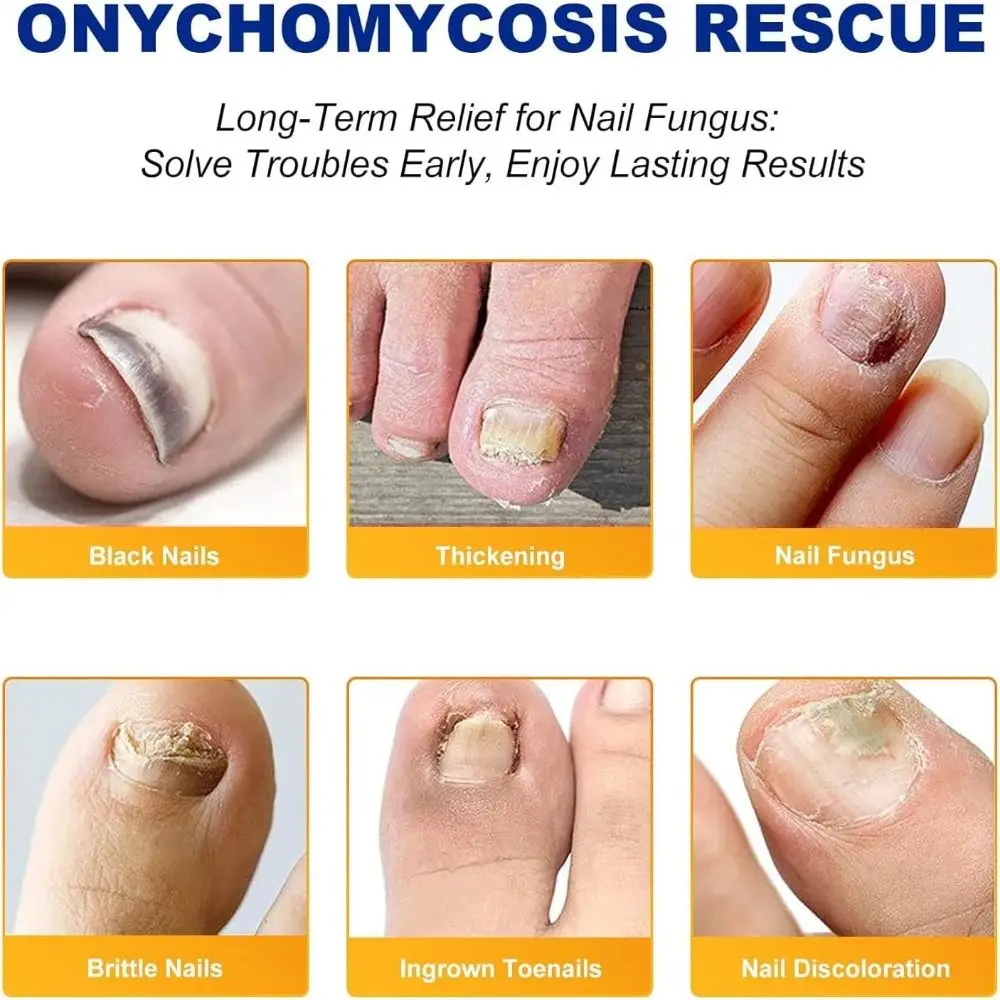 Parches de uñas hongos suaves, parches de reparación de uñas eficaces fáciles de usar, restauran la resistencia de las uñas, tratamiento de uñas hongos portátil