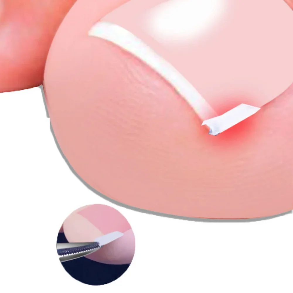 10pcs Ingrown Toenail Correction Tool Ingrown Toe Nail Treatment Elastic Patch Sticker Straightening Clip Brace Pedicure Tool image 2