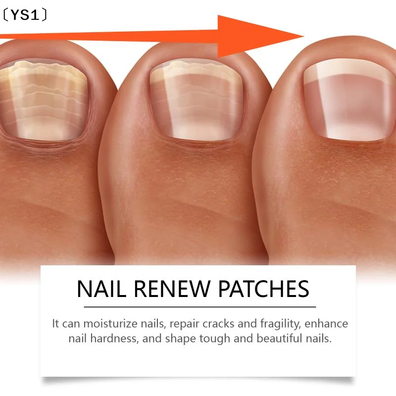 YS1Toenail Fungus  Stickers Ingrowning Toenail  Paronychia Repair Patch Fungus Removal Nail Repair Patch