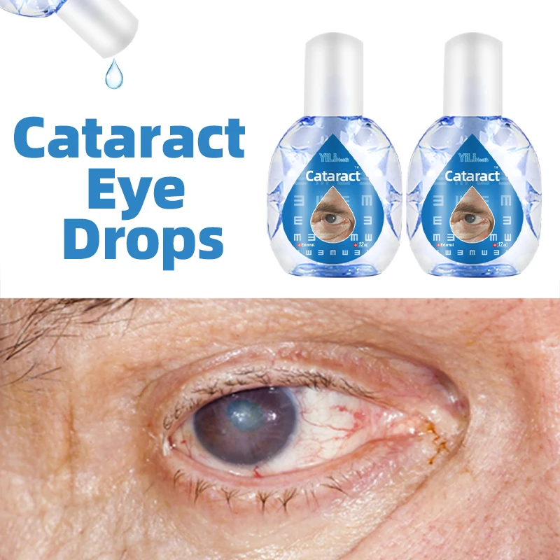 12ml Cataract Treatment Eye Drops for Dry Eyes Cloudy Eyeball Blurred Vision Cure and Black Shadow Removal Eyes Drops