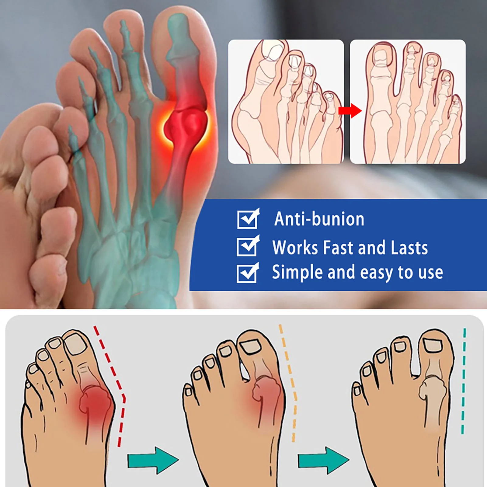 8pcs Anti Bunion Patches Bunion Corrector Toe Separator Orthopedic Straightener Foot Bunion Pain Swelling Relief Patch Foot Care