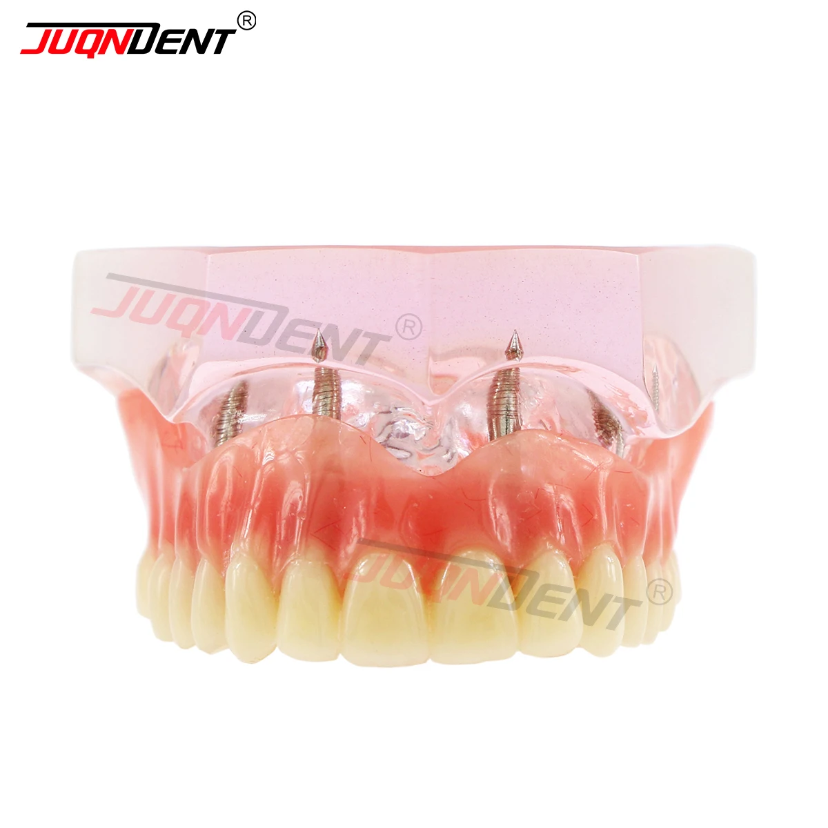 Dental Teaching Model Dental Implants Demo Dental Teeth Model 6001C Dental Upper Overdenture Superior Dental Model Practice Demo