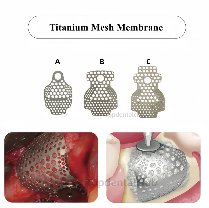 

Dental Implant Titanium Mesh GBR Implant 3D Membrane Barrier Titanium Plates