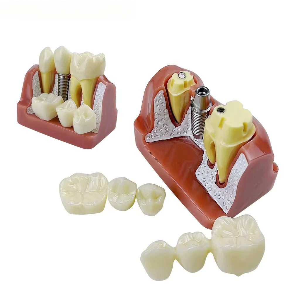 4 Times Dental Implant Teeth Model Dentistry Removable Analysis Crown Bridge Model For Studying Training Teaching Demonstration
