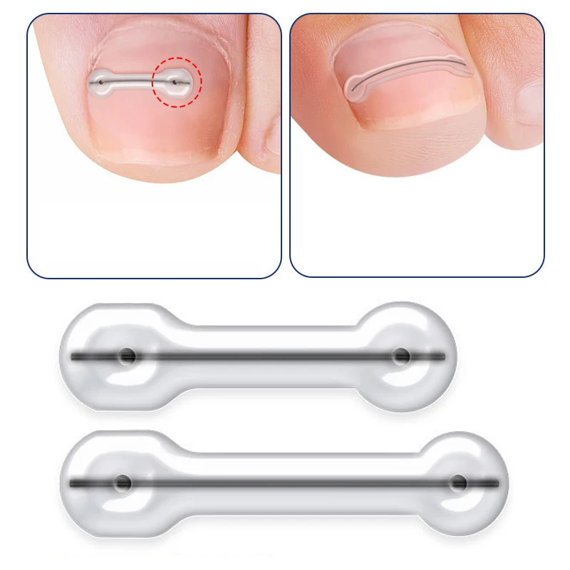 Ein gewachsene Zehen nagel korrektor Werkzeuge Pediküre erholen eingebettete Zehen nagel behandlung profession elle ein gewachsene Zehen nagel Glättung Clip Klammer