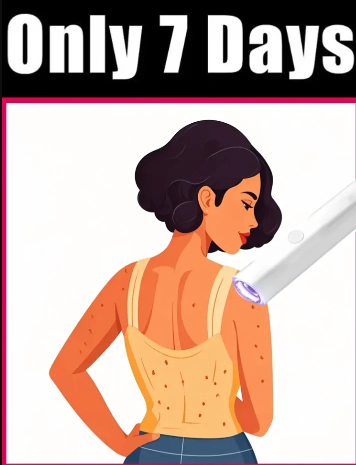 Warts Blue Light Tool, Easy To Clean Skin Care Tool