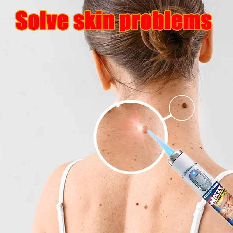 

2025 hot sale,blue light pen solve warts, wart care tools, unisex