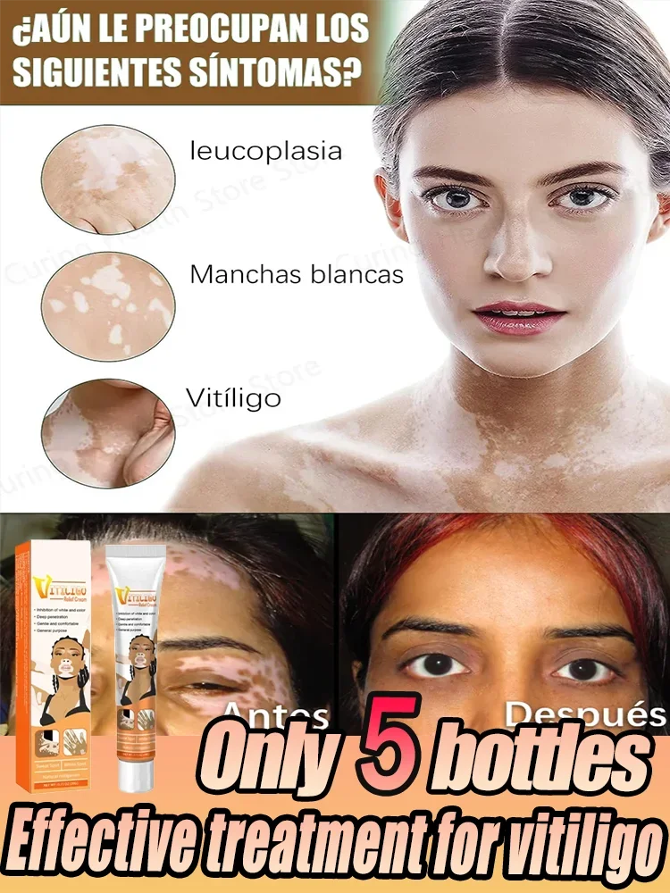 ⁿⁱᶜᵉ Vitiligo organic agent is suitable for white spot cream skin to repair pigmentation