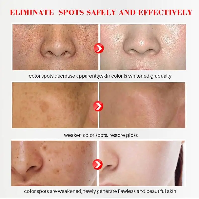 Dimollaure Whitening Freckle Cream Anti-wrinkle Removal Melasma Freckle Age Spot Pigment Melanin Brighten Face Skin Care