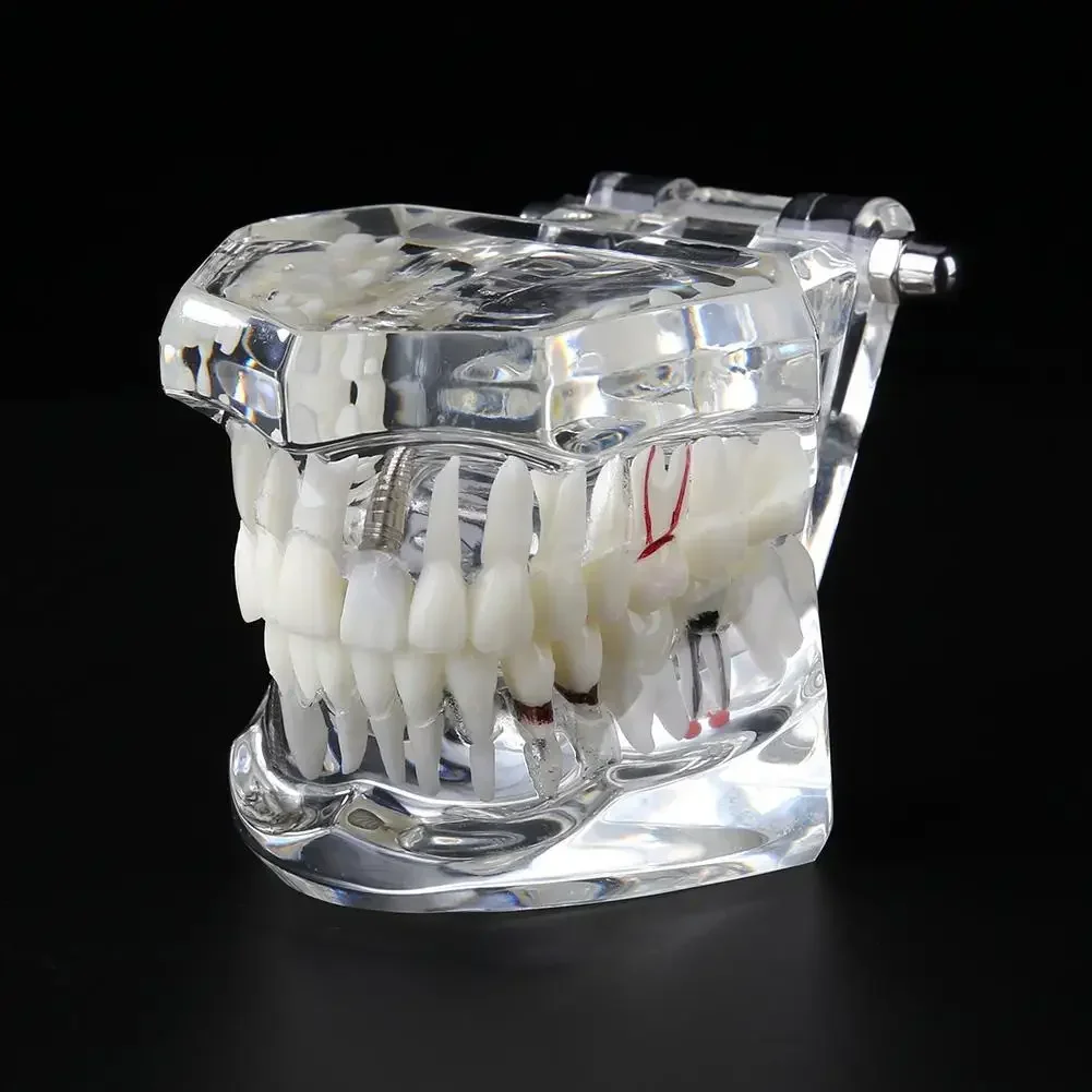 

Dental Model Teeth Implant Restoration Bridge Dentistry Teaching Study Tooth Medical Science Disease Products